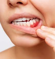 How to Prevent Gum Disease: A Calicut Guide